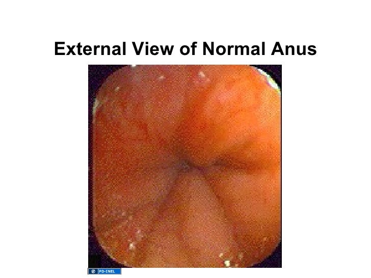 Icture of anormal anus Jock butt fuck